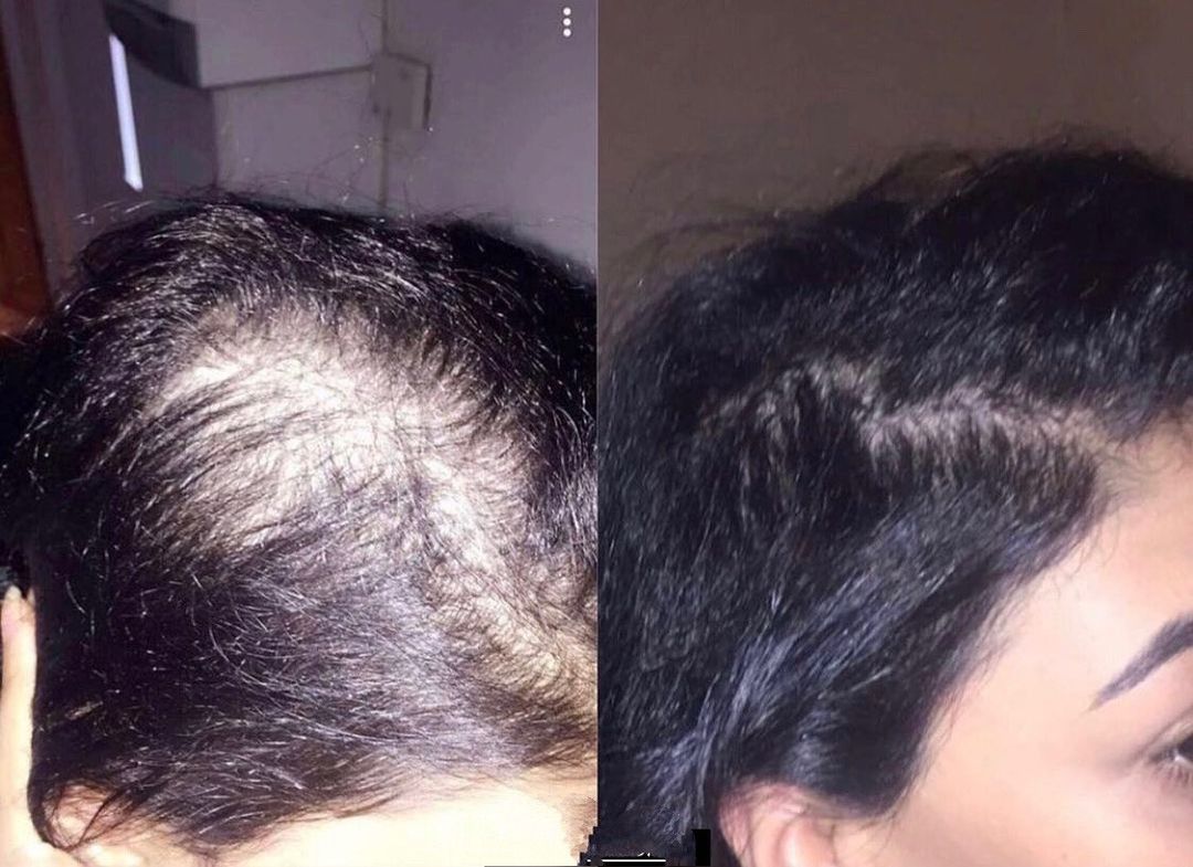 Antes e depois - Marina, 29 anos: O método me ensinou exatamente o que eu precisava — receitas fáceis, naturais e eficazes. Hoje meu cabelo está cheio de vida, e o melhor: fiz tudo em casa!